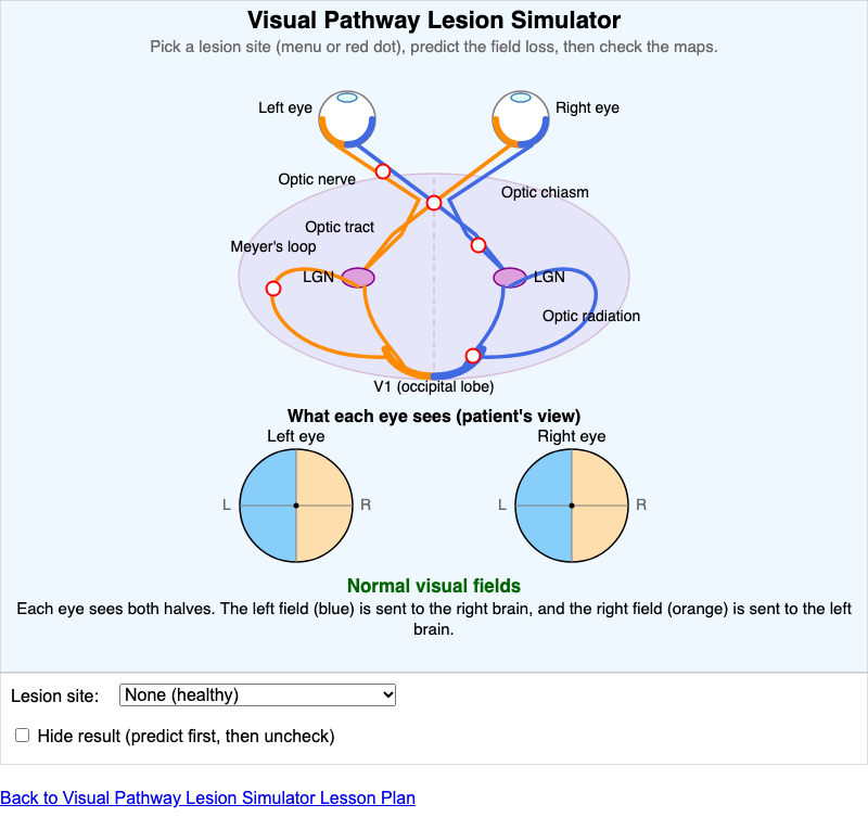 Visual Pathway Lesion Simulator